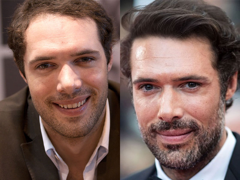 Célébrités françaises avec une greffe de cheveux