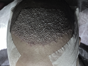 jours 1 après la greffe