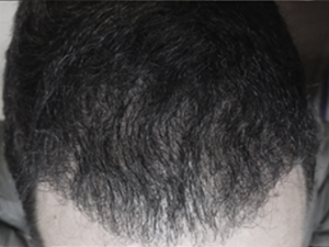 4 mois après la greffe