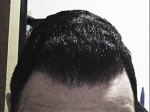 8 mois après la greffe