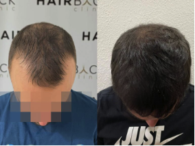 La greffe de cheveux 10 ans après l'opération