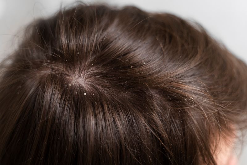 Dermatite séborrhéique et chute de cheveux CheveuxVital Blog capillaire