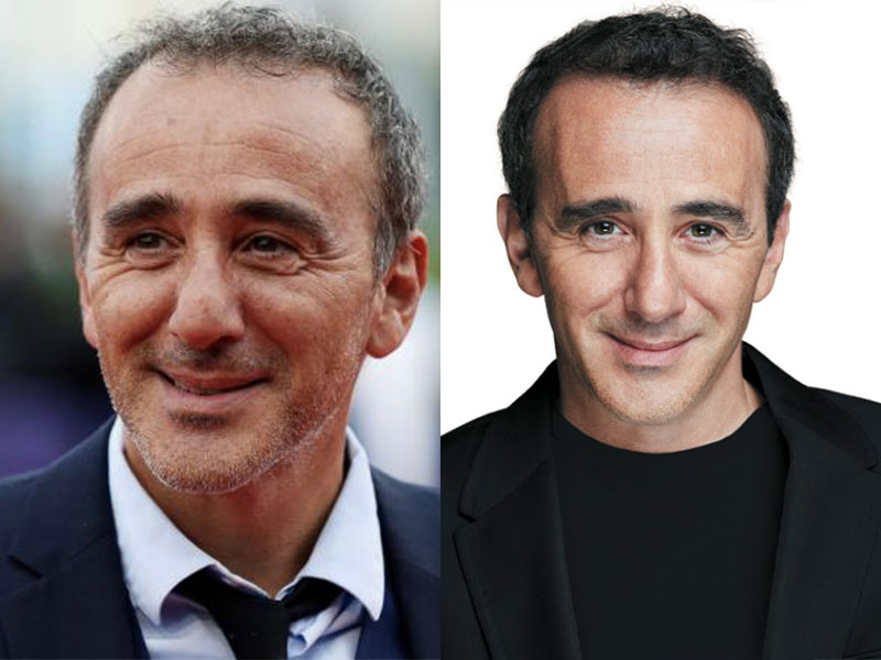 Célébrités françaises avec une greffe de cheveux