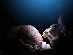 Technique FUE: Avantage et inconvénients