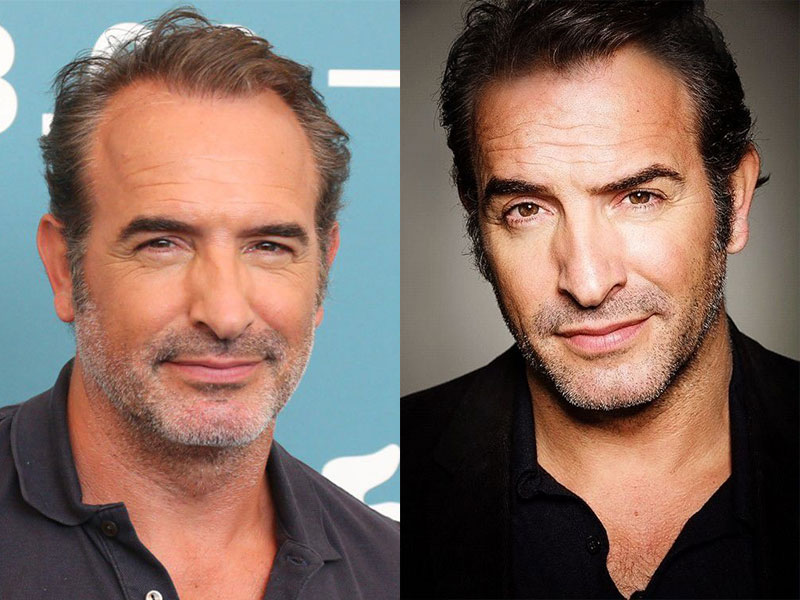 Célébrités françaises avec une greffe de cheveux