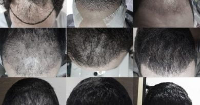 Évolution de la greffe de cheveux jour après jour