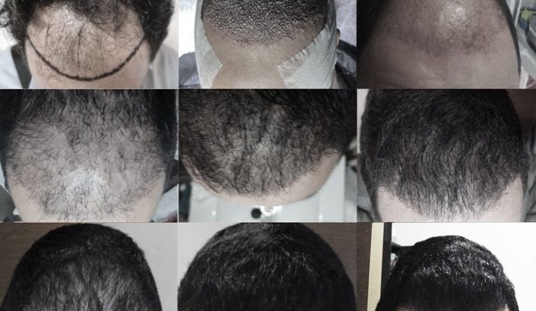 Évolution de la greffe de cheveux jour après jour