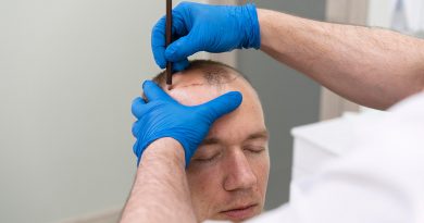 Technique FUE: Avantage et inconvénients - blog capillaire