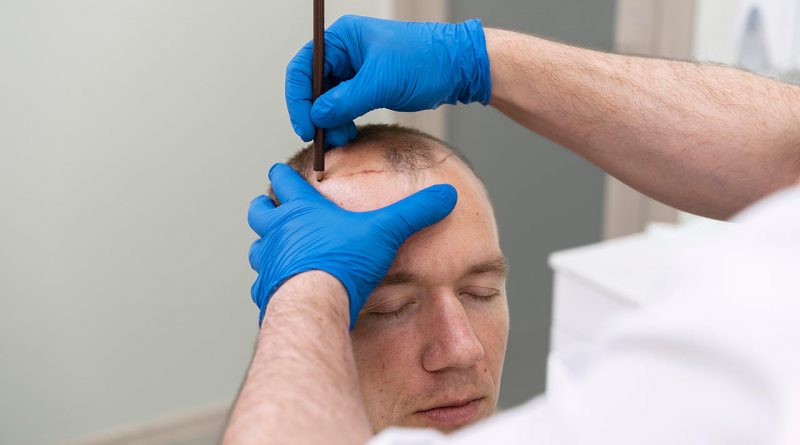Technique FUE: Avantage et inconvénients - blog capillaire