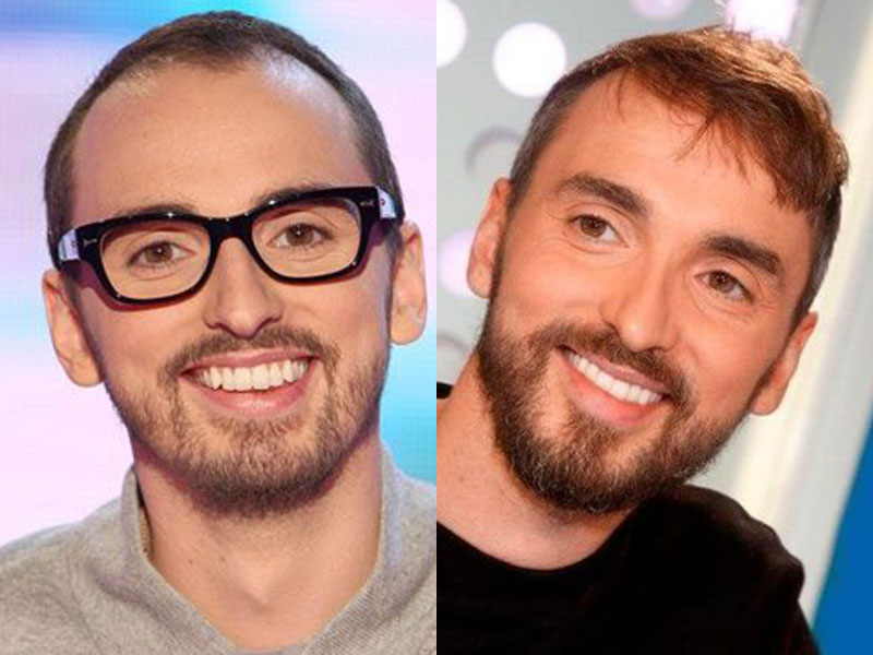 Célébrités françaises avec une greffe de cheveux