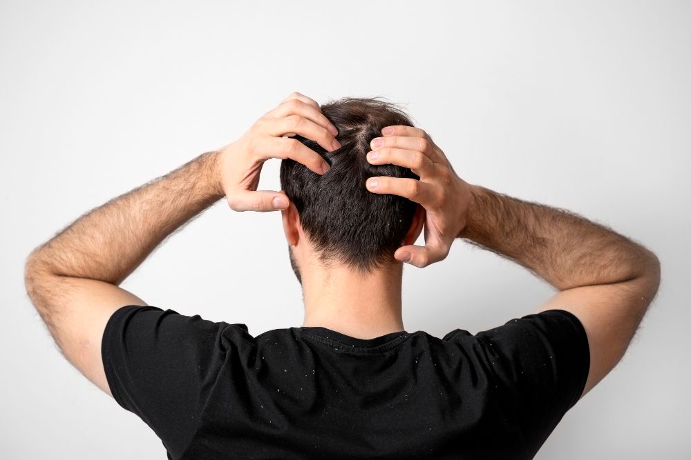 perte de cheveux