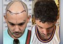 Dr. Cinik Hair Hospital – opinions