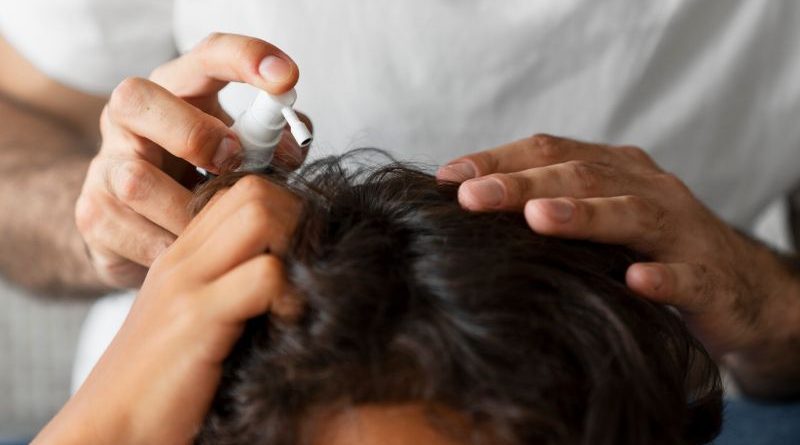 Les meilleurs traitements pour soigner les Pellicules